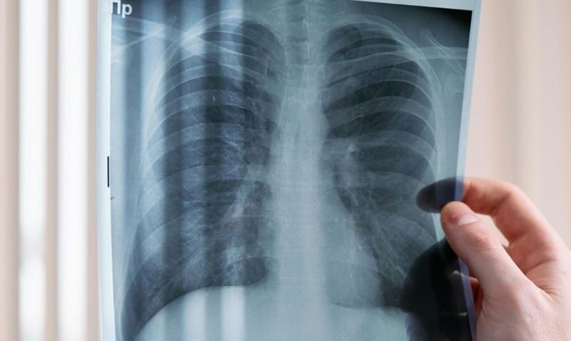 Cáncer de pulmón en México: ¿además del tabaco qué otras cosas lo causa?