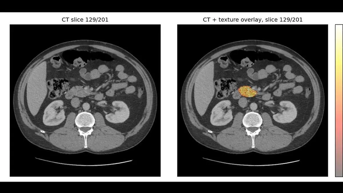Inteligencia Artificial permitiría diagnosticar cáncer de páncreas antes de que sea visible