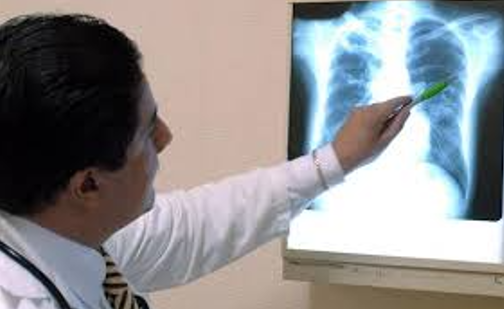 Veracruz, segundo lugar nacional en tuberculosis